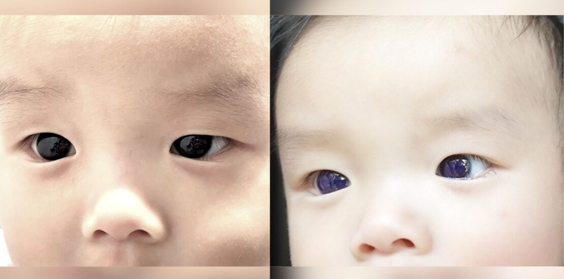 Infants Eye Color Change Raises Questions After COVID Treatment Instantly Interpret Free: Legalese Decoder - AI Lawyer Translate Legal docs to plain English