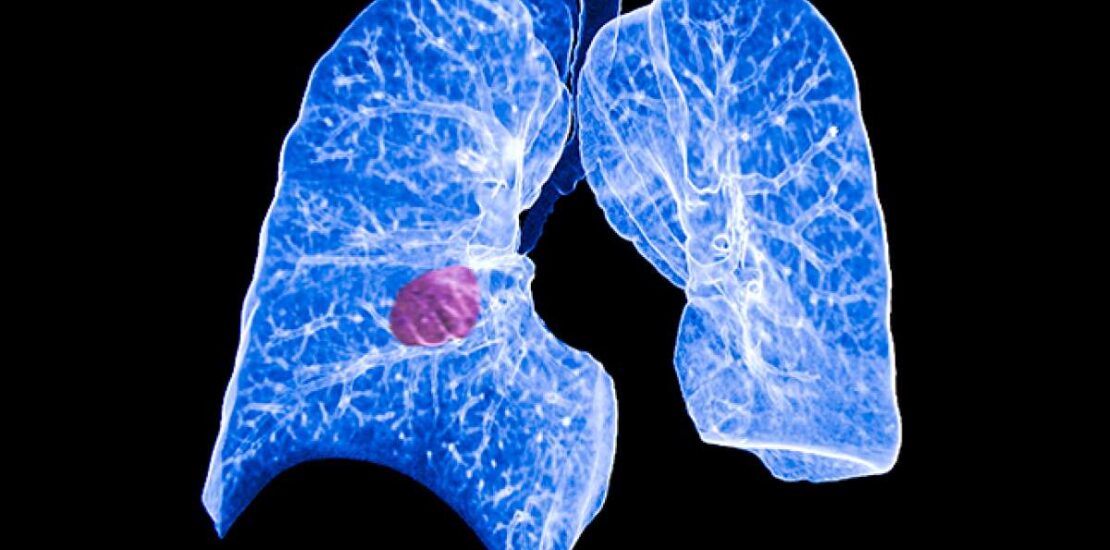 Targeted Therapy Lowers Lung Cancer Recurrence Risk by 83 Instantly Interpret Free: Legalese Decoder - AI Lawyer Translate Legal docs to plain English